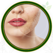 Scar & Blemish Removal